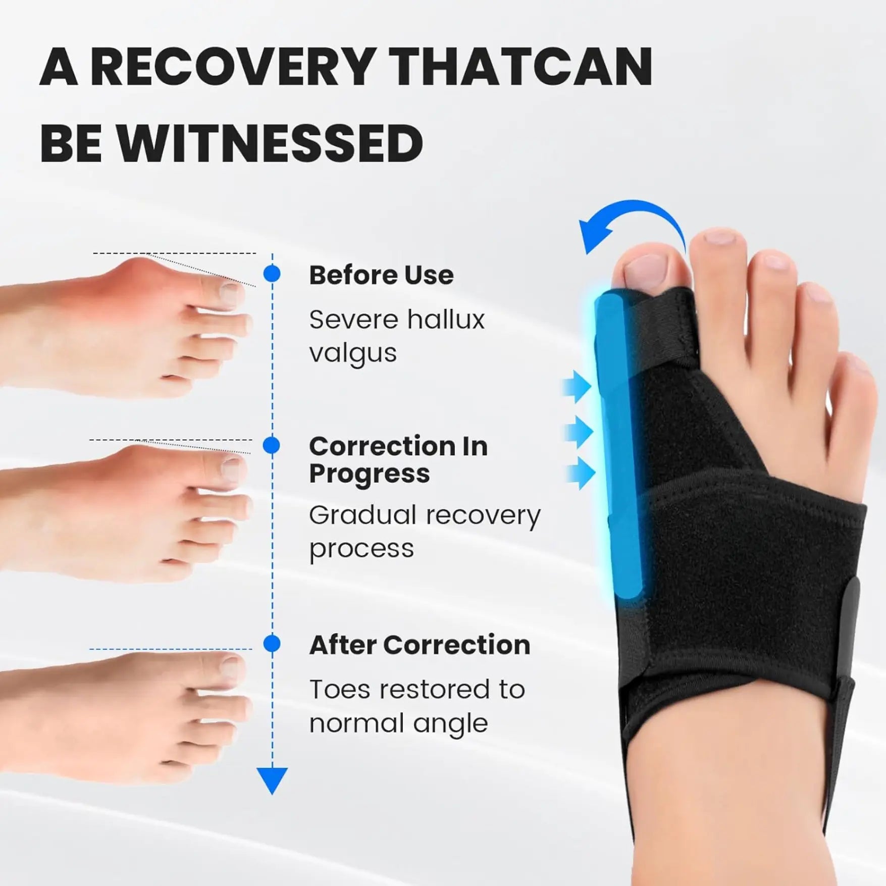 Slumblr® Bunion Corrector for Big Toe Straightener (2pcs) Slumblr